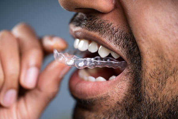 man with aligners in mouth