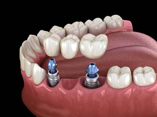 Dental Bridges