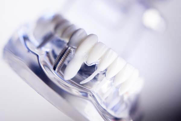 Dental Implants