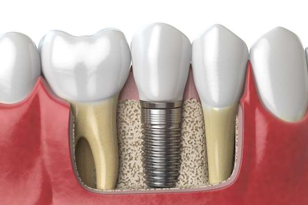 dental implants example