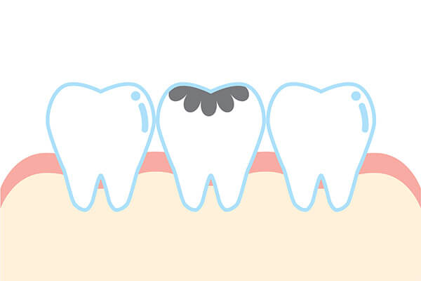 how are cavities treated