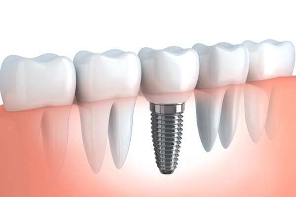 dental implant