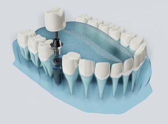 FAQs about Dental Implants